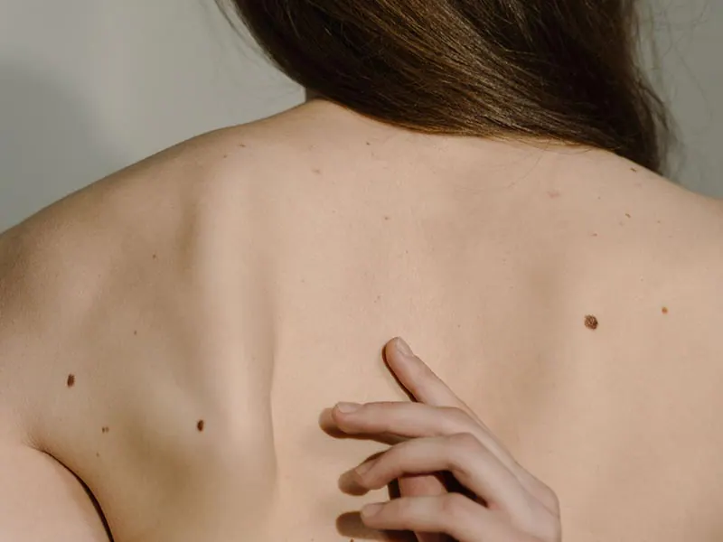 Skin Cancer Screening and Mole Checks in Hout Bay: When Should You Have a Skin Spot Examined?